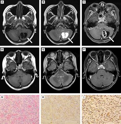 A Novel RNF139 Mutation in Hemangioblastomas: Case Report